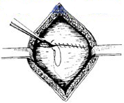 宫剪怎么样收藏！产科经典手术“子宫下段剖宫产术”步骤，图文详解！_https://www.jmylbn.com_新闻资讯_第18张