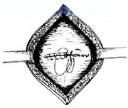 宫剪怎么样收藏！产科经典手术“子宫下段剖宫产术”步骤，图文详解！_https://www.jmylbn.com_新闻资讯_第16张