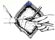 宫剪怎么样经典剖宫产术：从切开腹壁到娩出胎儿，10大操作步骤，图片讲解＞_https://www.jmylbn.com_新闻资讯_第16张