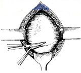 宫剪怎么样经典剖宫产术：从切开腹壁到娩出胎儿，10大操作步骤，图片讲解＞_https://www.jmylbn.com_新闻资讯_第5张