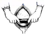 宫剪怎么样经典剖宫产术：从切开腹壁到娩出胎儿，10大操作步骤，图片讲解＞_https://www.jmylbn.com_新闻资讯_第8张