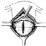 宫剪怎么样经典剖宫产术：从切开腹壁到娩出胎儿，10大操作步骤，图片讲解＞_https://www.jmylbn.com_新闻资讯_第10张