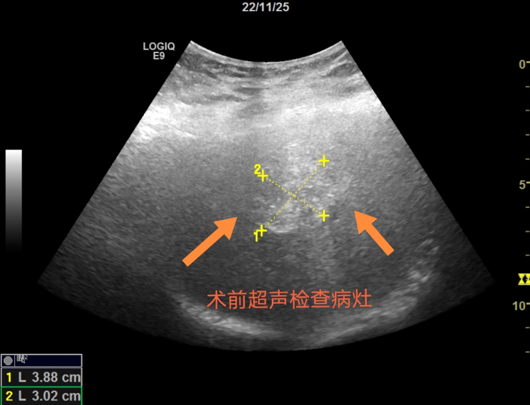微波针是什么“一针”下去肿瘤就没了？“针尖上的技术”消灭“肿瘤”君_https://www.jmylbn.com_新闻资讯_第2张