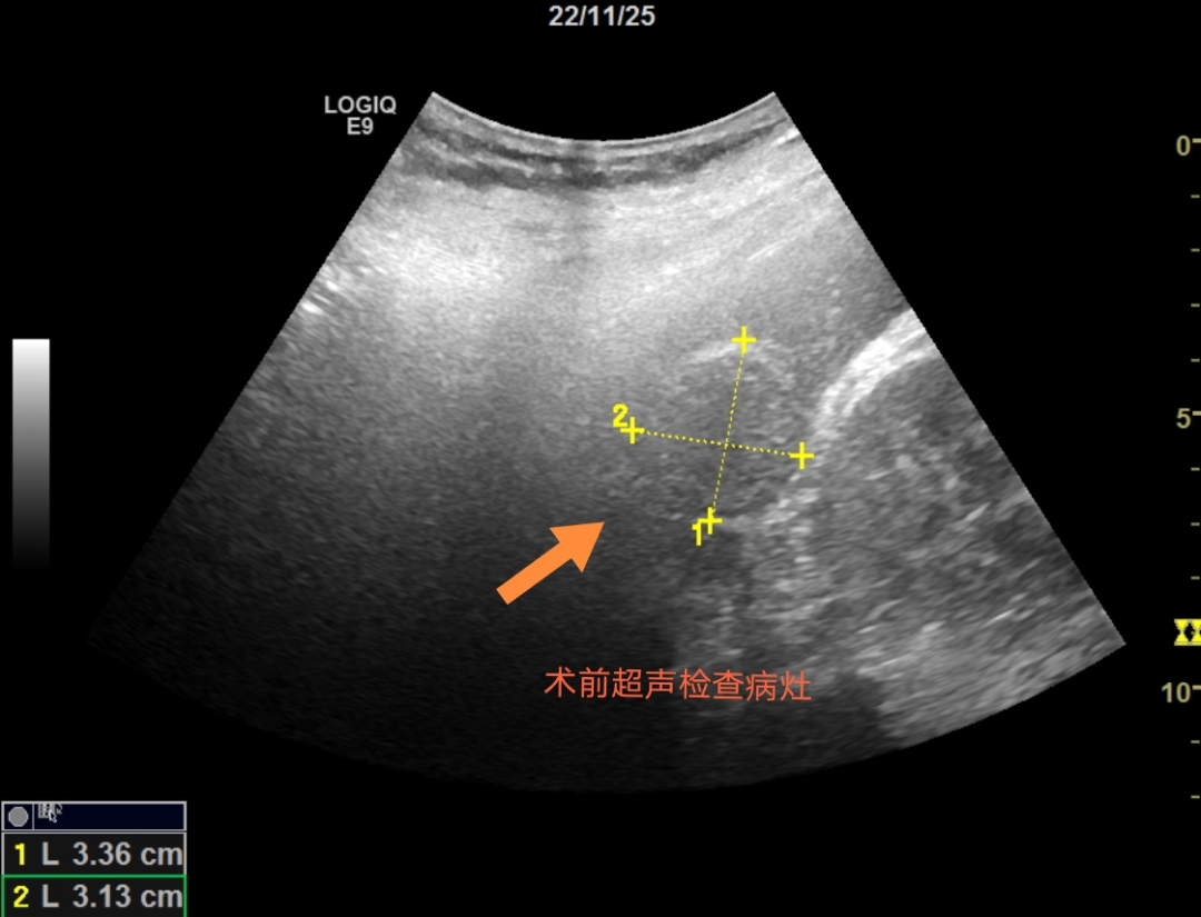 微波针是什么“一针”下去肿瘤就没了？“针尖上的技术”消灭“肿瘤”君_https://www.jmylbn.com_新闻资讯_第3张