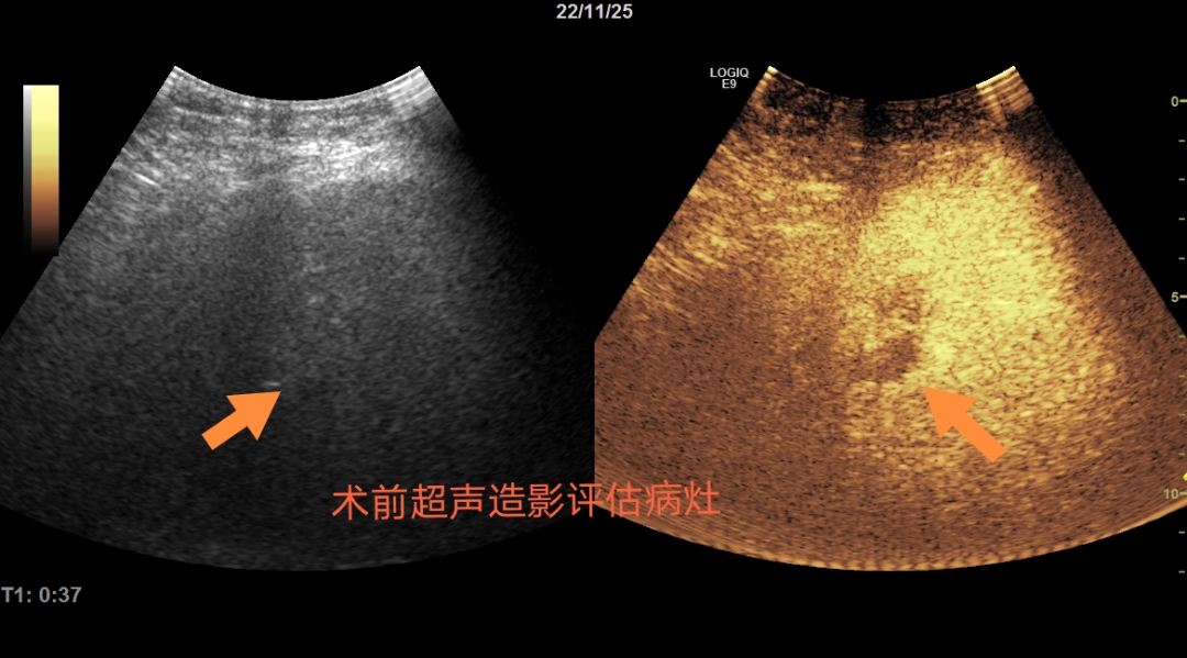 微波针是什么“一针”下去肿瘤就没了？“针尖上的技术”消灭“肿瘤”君_https://www.jmylbn.com_新闻资讯_第4张