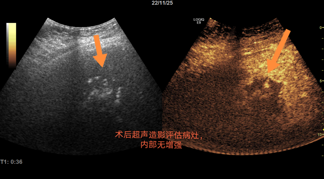 微波针是什么“一针”下去肿瘤就没了？“针尖上的技术”消灭“肿瘤”君_https://www.jmylbn.com_新闻资讯_第5张