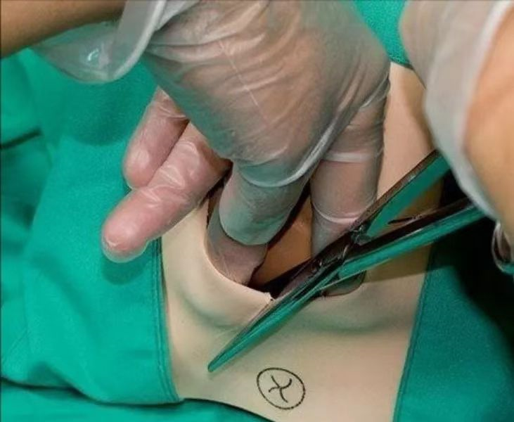 撕裂缝线不吸收怎么办为何顺产侧切的缝线，5个月还没吸收好？医生：这件事产妇越早做越好_https://www.jmylbn.com_新闻资讯_第4张