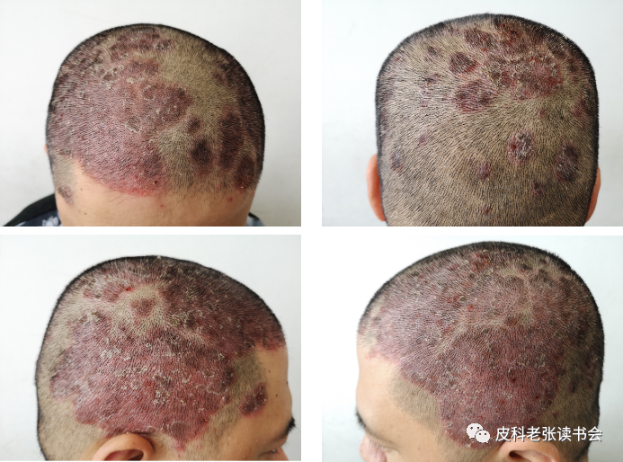 头皮银屑病的诊断容不容易？Itdepends!