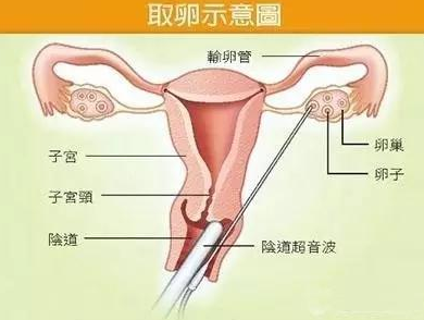 什么人在代孕？代孕的真实风险有多大？