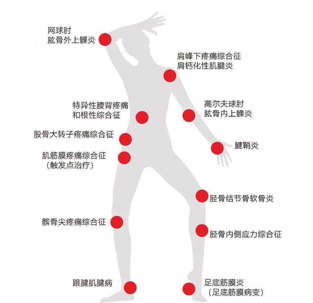 冲击波治疗效果怎么样体外冲击波治疗颈肩腰腿痛效果好_https://www.jmylbn.com_新闻资讯_第10张