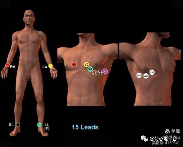 心电图mm单位怎么读12导、15导、18导连接示意图及心脏各壁超声解剖位置与心电图导联对应关系_https://www.jmylbn.com_新闻资讯_第4张