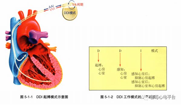 心电图vp是什么【心系列398】DDl起搏心电图-上海聚慕医疗器械有限公司