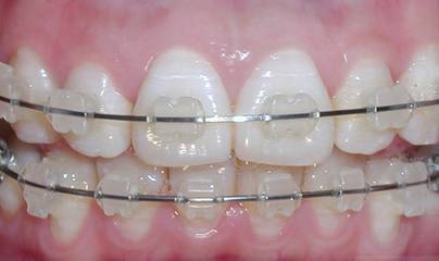 口腔耗材怎么开15省口腔正畸耗材集采启动！“大钢牙”与“隐形牙套”七折起步，为期两年_https://www.jmylbn.com_新闻资讯_第4张