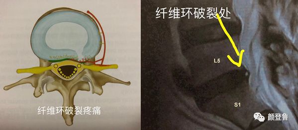2,纤维环的放射状撕裂1,纤维环的环状撕裂二,椎间