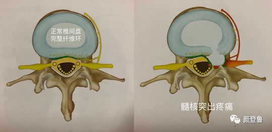 椎間盤纖維環破裂性腰腿痛