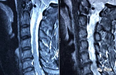 颈5 6椎间盘突出症的微创治疗
