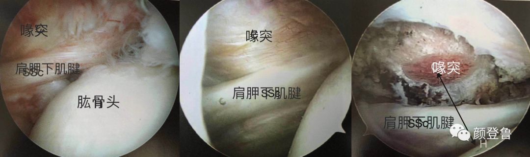 肩袖肩胛下肌腱损伤的诊断和治疗 - 好大夫在线