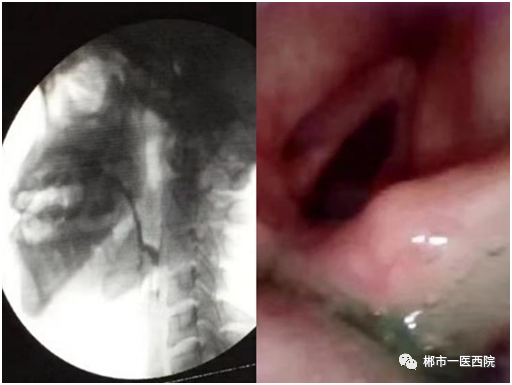 纤维喉镜怎么检查纤维喉镜吞咽功能检查（FEES）     助力吞咽障碍康复诊疗_https://www.jmylbn.com_新闻资讯_第4张