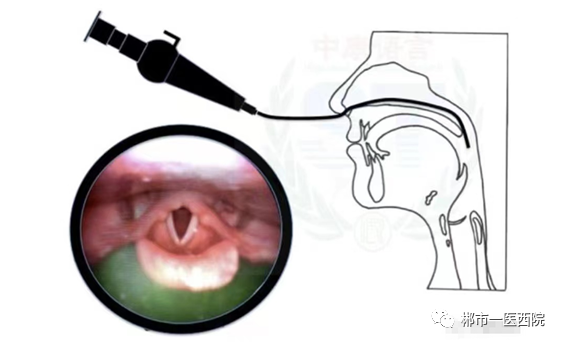 纤维喉镜怎么检查纤维喉镜吞咽功能检查（FEES）     助力吞咽障碍康复诊疗_https://www.jmylbn.com_新闻资讯_第3张