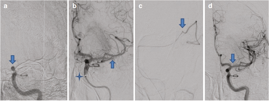 动脉长鞘怎么置入急性大血管闭塞性脑卒中的血管内再灌注治疗_https://www.jmylbn.com_新闻资讯_第3张