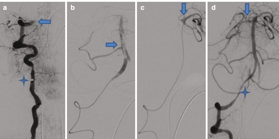 动脉长鞘怎么置入急性大血管闭塞性脑卒中的血管内再灌注治疗_https://www.jmylbn.com_新闻资讯_第2张