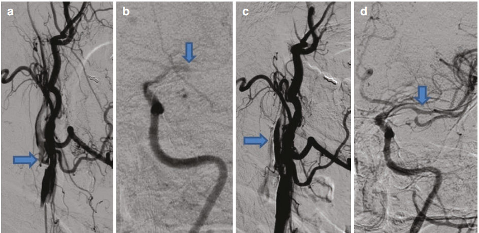 动脉长鞘怎么置入急性大血管闭塞性脑卒中的血管内再灌注治疗_https://www.jmylbn.com_新闻资讯_第4张
