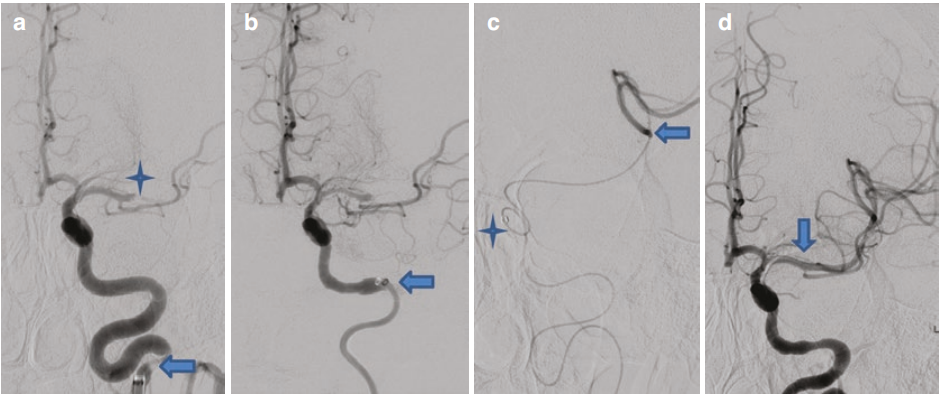 动脉长鞘怎么置入急性大血管闭塞性脑卒中的血管内再灌注治疗_https://www.jmylbn.com_新闻资讯_第1张