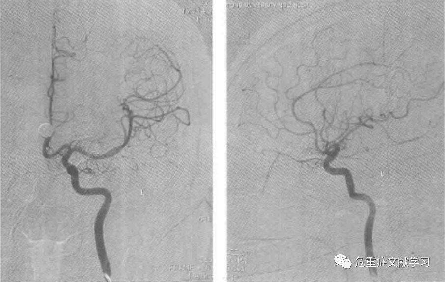 大腦中動脈狹窄診斷及治療 健康 第7張