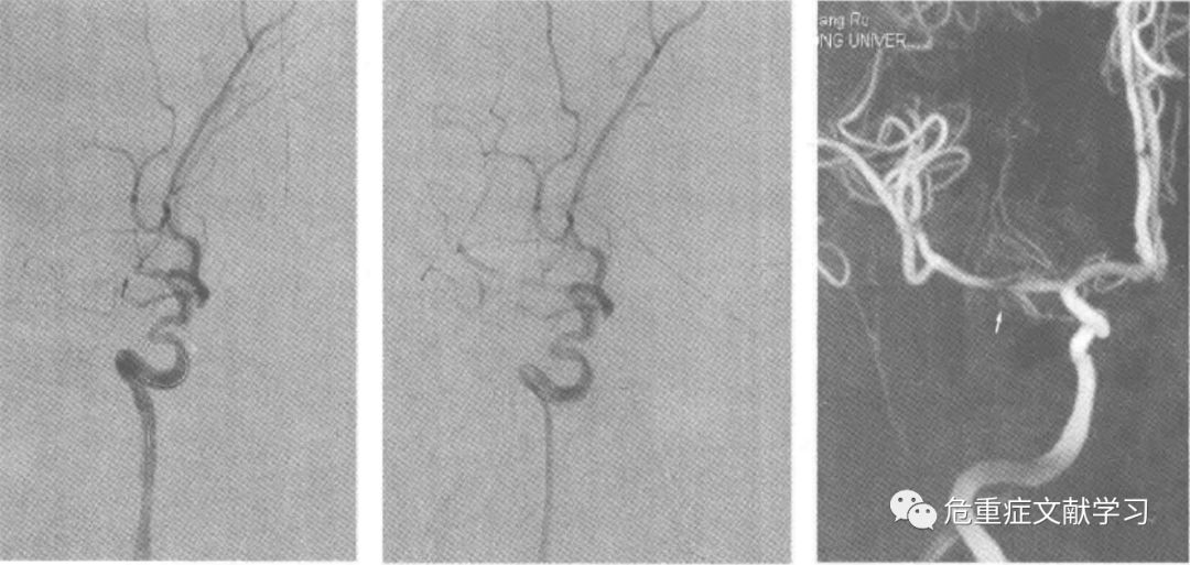 大腦中動脈狹窄診斷及治療 健康 第13張