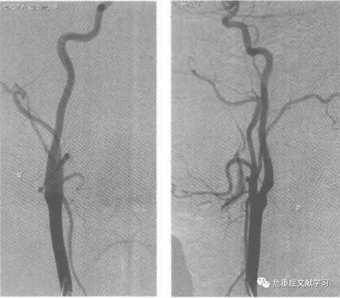 大腦中動脈狹窄診斷及治療 健康 第3張