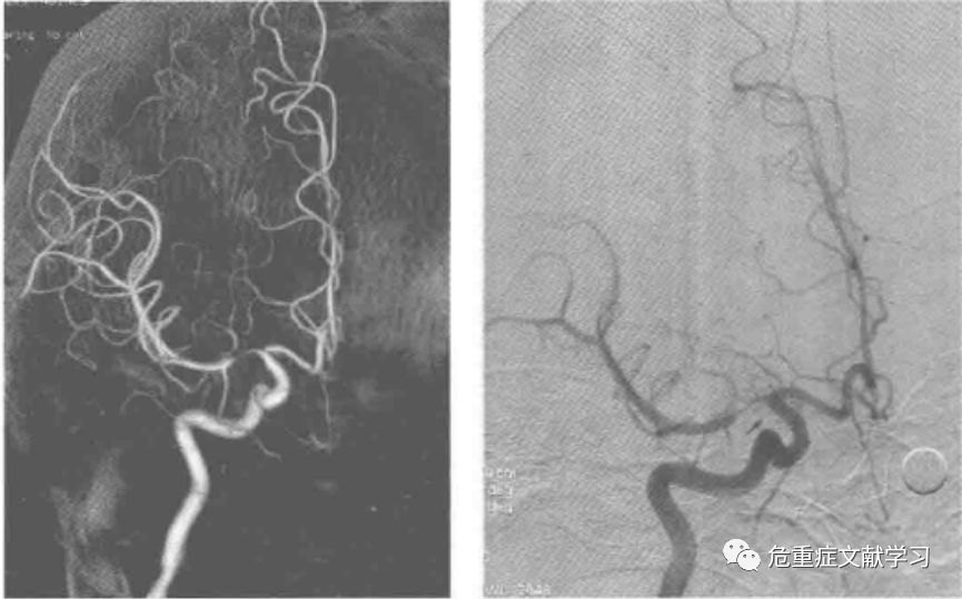 大腦中動脈狹窄診斷及治療 健康 第5張