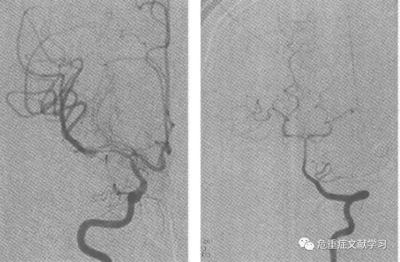 大腦中動脈狹窄診斷及治療 健康 第18張