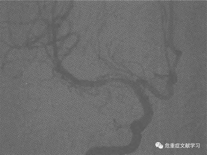 大腦中動脈狹窄診斷及治療 健康 第16張