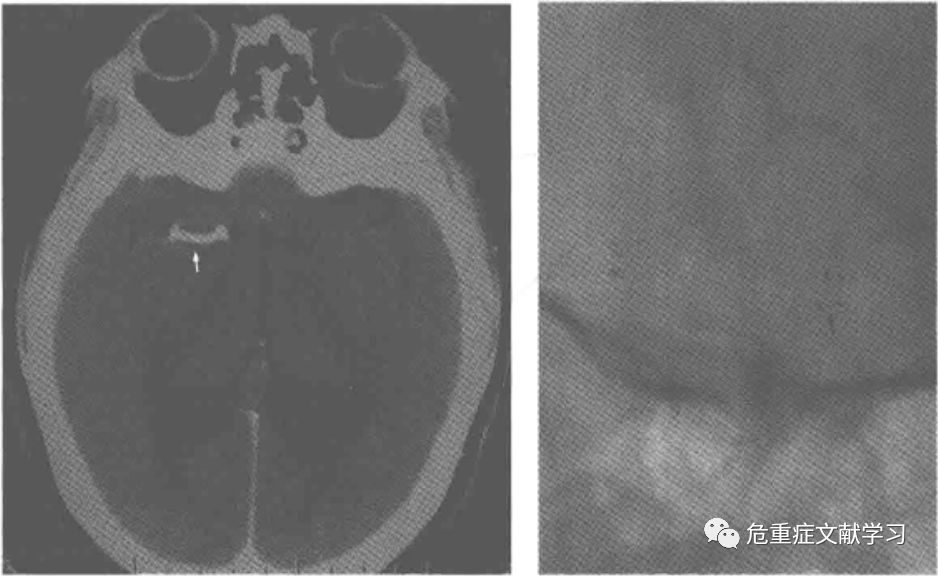 大腦中動脈狹窄診斷及治療 健康 第17張