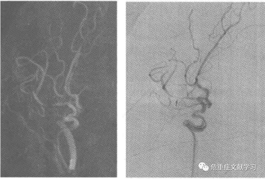 大腦中動脈狹窄診斷及治療 健康 第11張