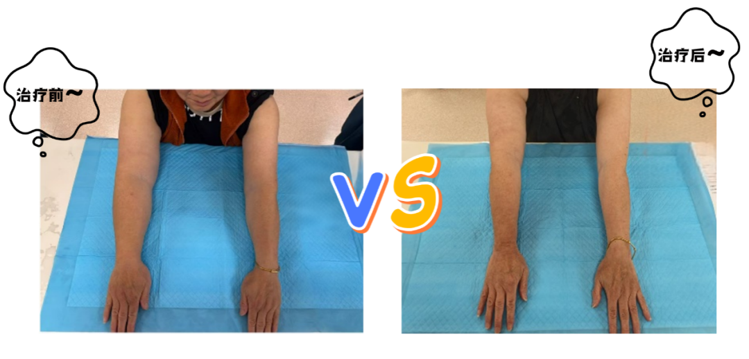 压力绷带为什么那么贵健康知识 ｜ 被束缚的右手——5年淋巴水肿的通关攻略_https://www.jmylbn.com_新闻资讯_第4张