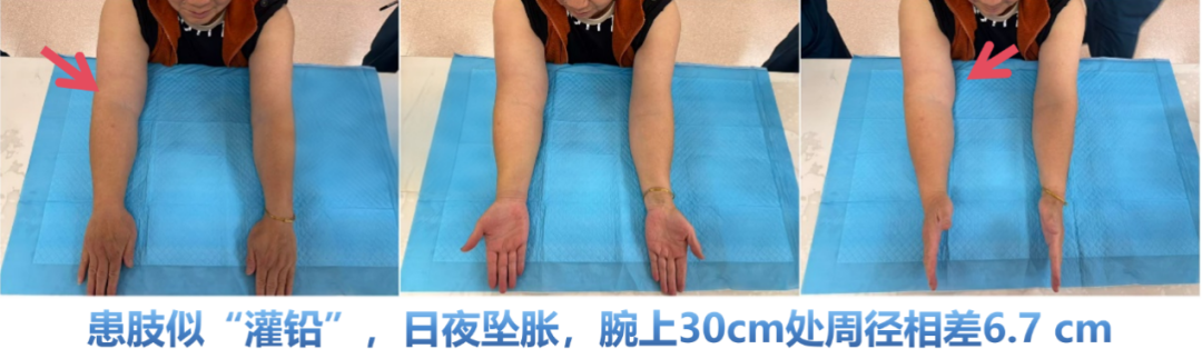 压力绷带为什么那么贵健康知识 ｜ 被束缚的右手——5年淋巴水肿的通关攻略_https://www.jmylbn.com_新闻资讯_第3张