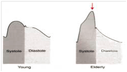 压力波是什么波正确认识动脉压力波形_https://www.jmylbn.com_新闻资讯_第4张