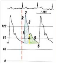 压力波是什么波正确认识动脉压力波形_https://www.jmylbn.com_新闻资讯_第5张
