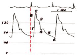 压力波是什么波正确认识动脉压力波形_https://www.jmylbn.com_新闻资讯_第2张