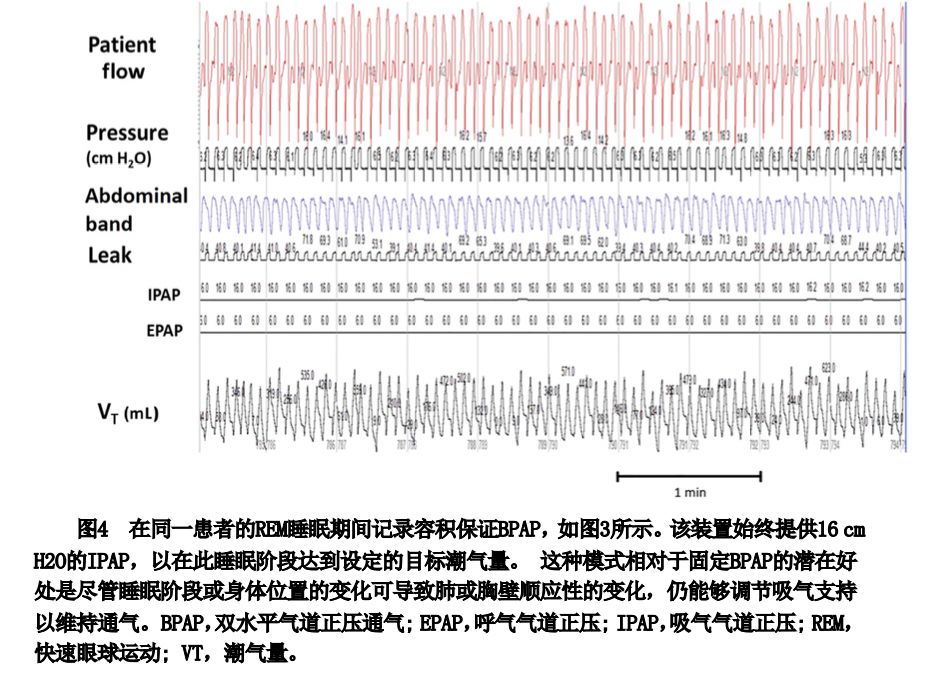 epap什么模式无创正压气道技术的进展_https://www.jmylbn.com_新闻资讯_第23张
