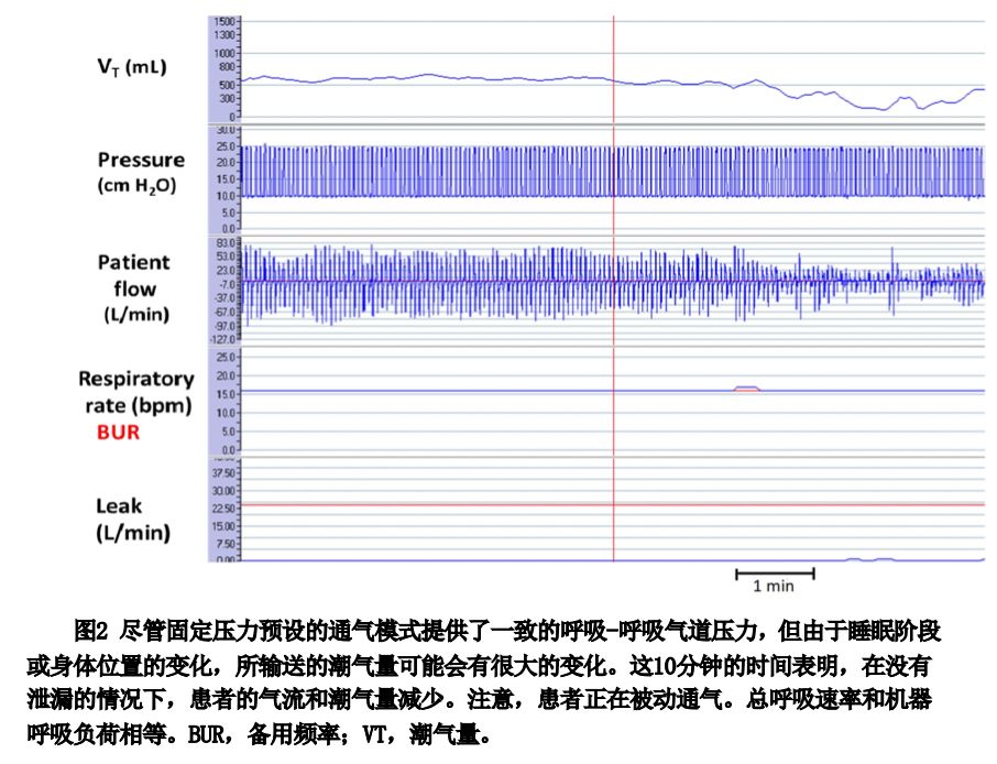 epap什么模式无创正压气道技术的进展_https://www.jmylbn.com_新闻资讯_第19张