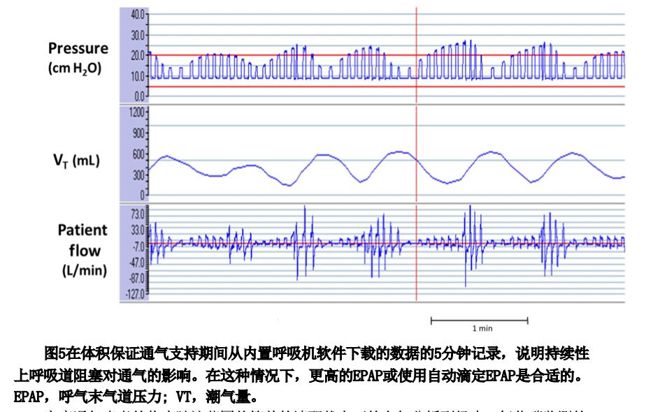 epap什么模式无创正压气道技术的进展_https://www.jmylbn.com_新闻资讯_第26张