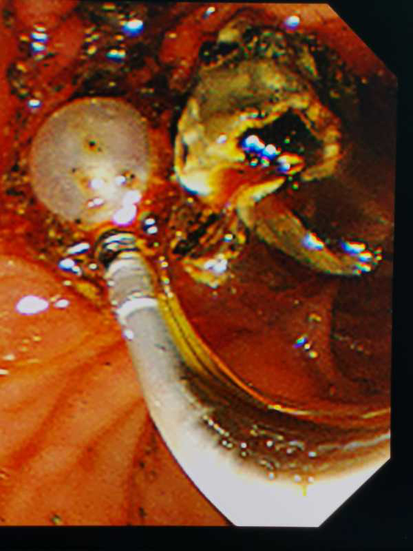 取石篮是什么小小结石  “胆”敢来犯——记平湖二院又一例ERCP微创胆道取石术_https://www.jmylbn.com_新闻资讯_第4张