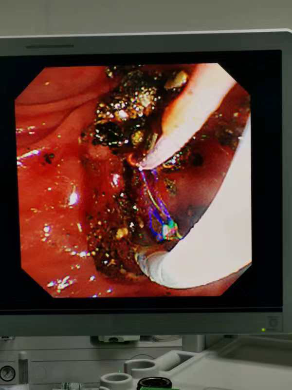 取石篮是什么小小结石  “胆”敢来犯——记平湖二院又一例ERCP微创胆道取石术_https://www.jmylbn.com_新闻资讯_第3张