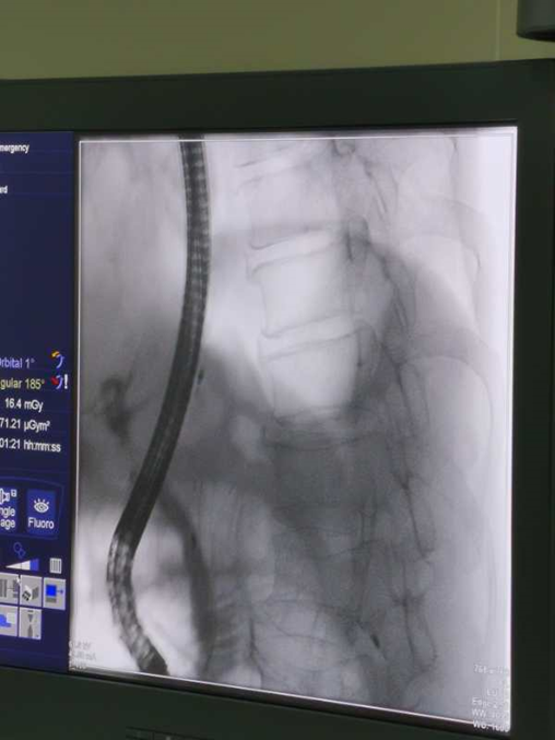 取石篮是什么小小结石  “胆”敢来犯——记平湖二院又一例ERCP微创胆道取石术_https://www.jmylbn.com_新闻资讯_第5张