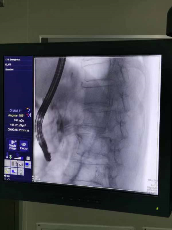 取石篮是什么小小结石  “胆”敢来犯——记平湖二院又一例ERCP微创胆道取石术_https://www.jmylbn.com_新闻资讯_第2张