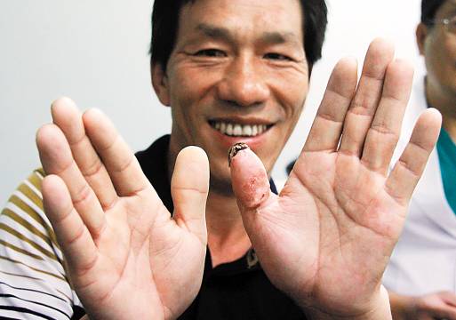 断指再植术后有哪些注意事项？术后疼痛怎么办？