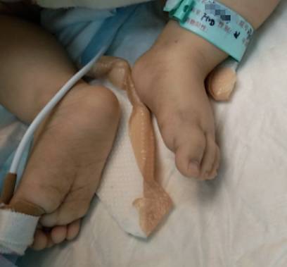新生儿紫绀症状图片图片