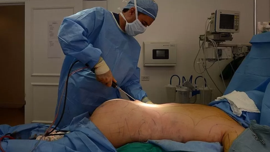 提臀术是医美行业的一场噩梦 - ellemen睿士 - 瓦斯阅读